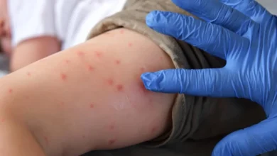 Growing Pennsylvania measles outbreak 4 Growing Pennsylvania measles