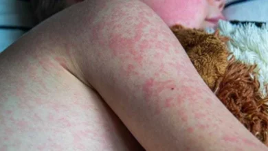 Pennsylvania Measles Outbreak