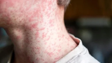 Wisconsin measles outbreak