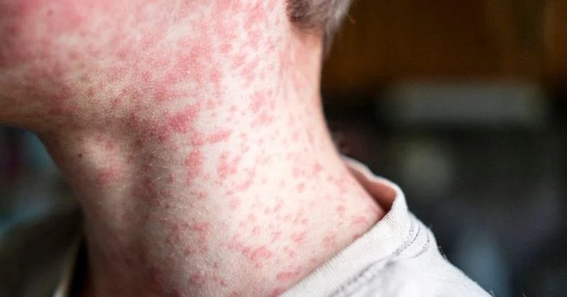 Wisconsin measles outbreak